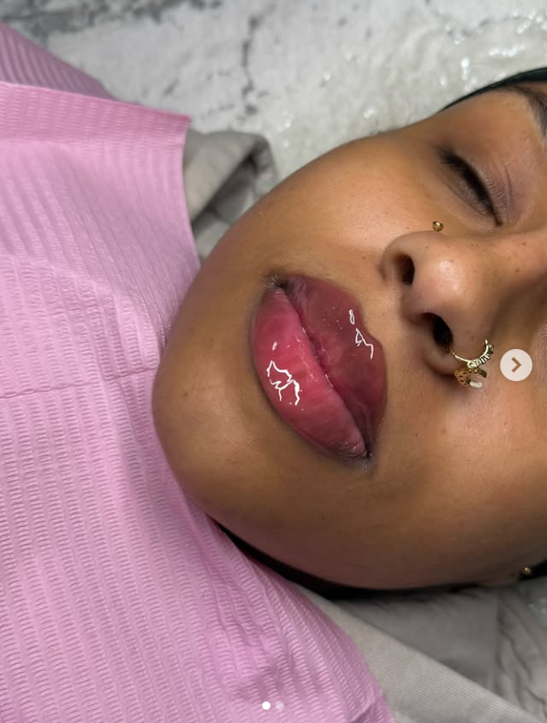 After 1ml Russian lips lifted and plumped