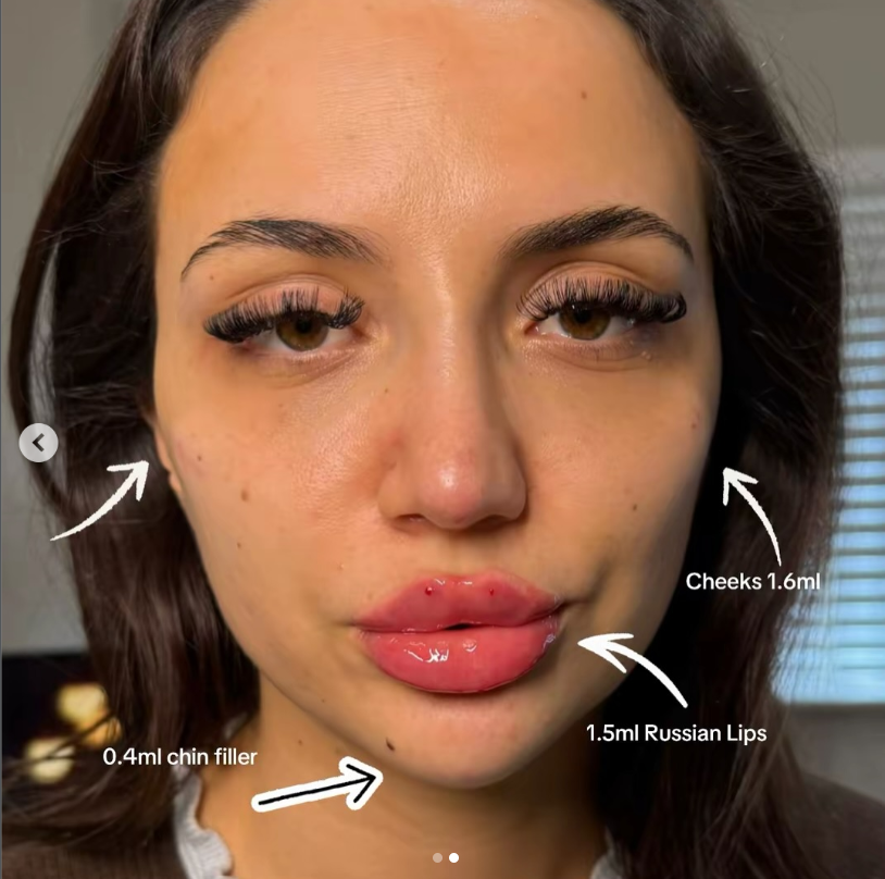 After 3.5ml facial balancing