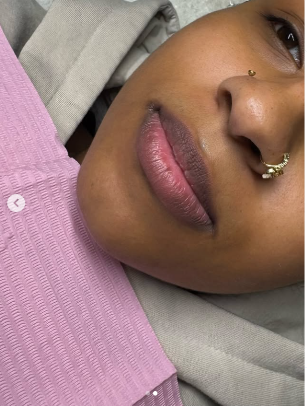 Before 1ml Russian lips lifted and plumped