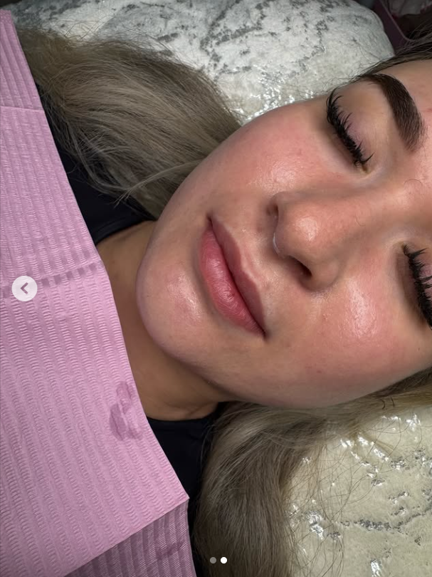 Before 1ml Lip Filler