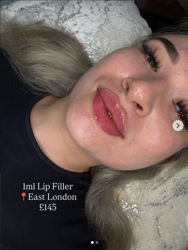 After 1ml Lip Filler
