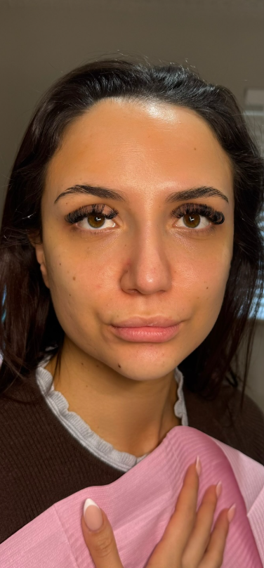 Before 3.5ml facial balancing