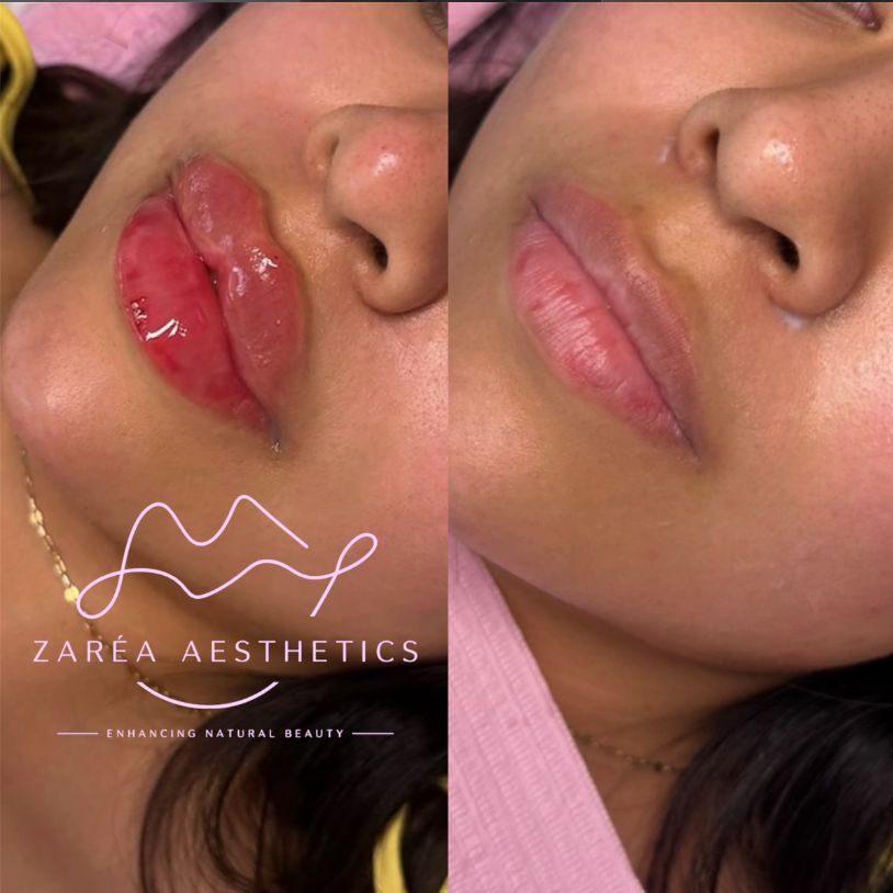 Lip-Fillers
