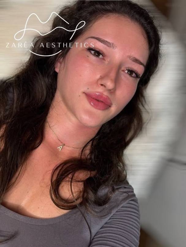 Lip-Fillers