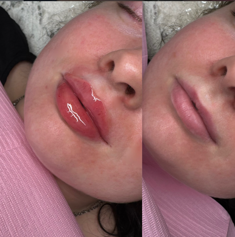 Lip-Fillers