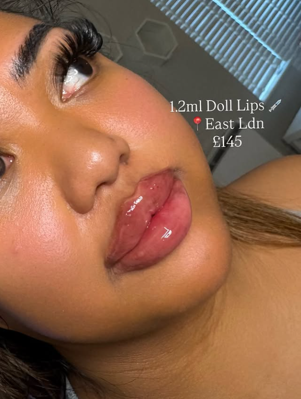 Lip-Fillers